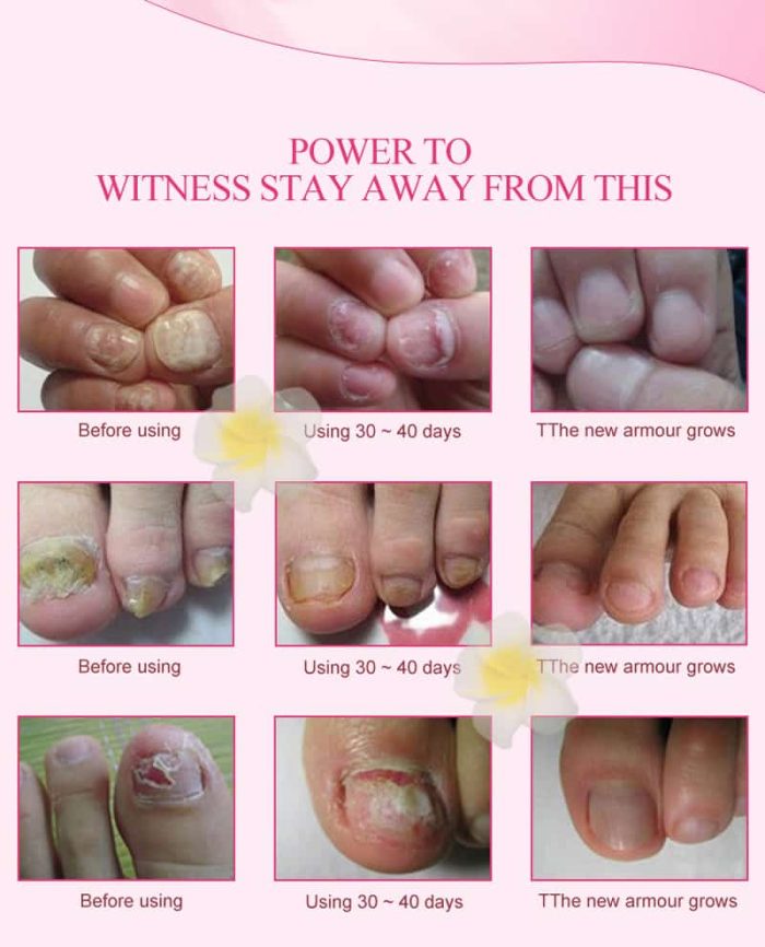 Meiyanqiong-Herbal-Nail-Fungus-Treatment-Onychomycosis-Paronychia-Anti-Fungal-Nail-Infection-Chinese-Herbs-Toe-Nail-Repair